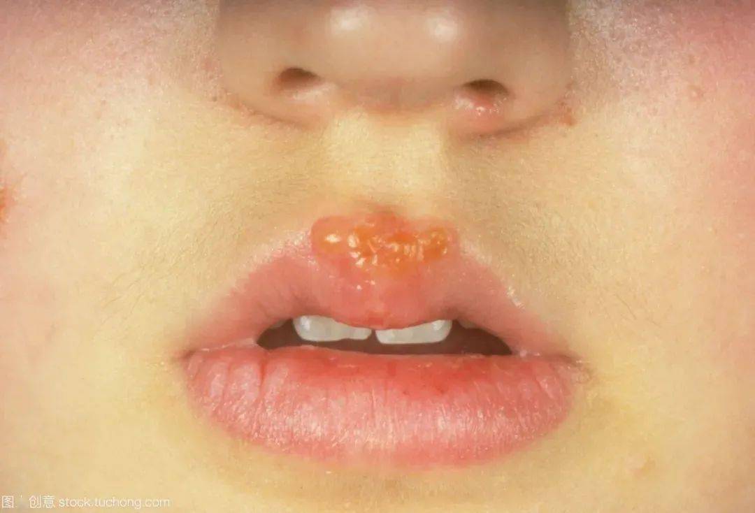 嘴唇上长疱,我们常说是"上火",实际上这是由单纯疱疹病毒(hsv)感染