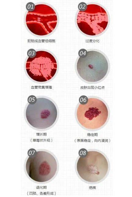 血管瘤需要治疗吗? 血管瘤当然要治疗!