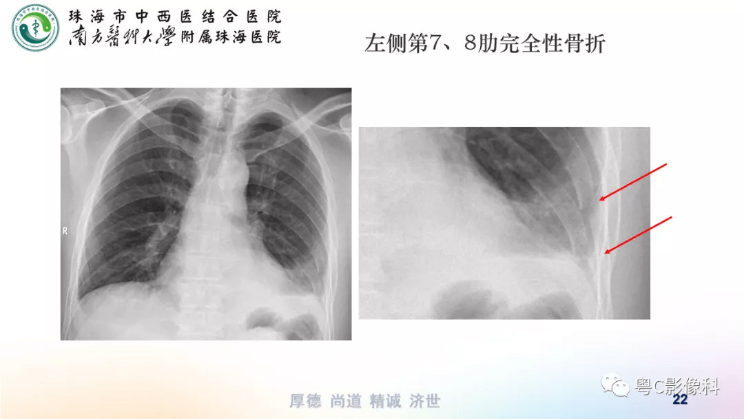 气胸胸腔积液肋骨骨折影像表现