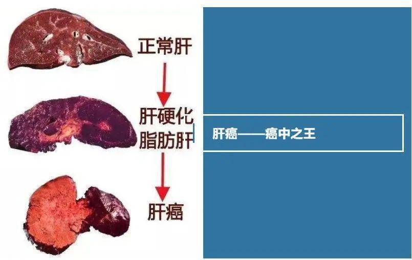 河西学院附属张掖人民医院肝癌介入治疗再添硬核新武器载药微球