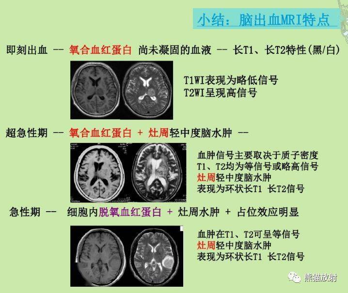 脑出血mri信号变化记不住这篇文章不要错过