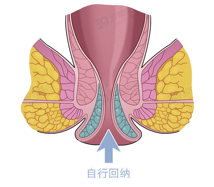 也是可以自行缩回即使直肠粘膜从肛门脱出此时情况并不严重就可能在