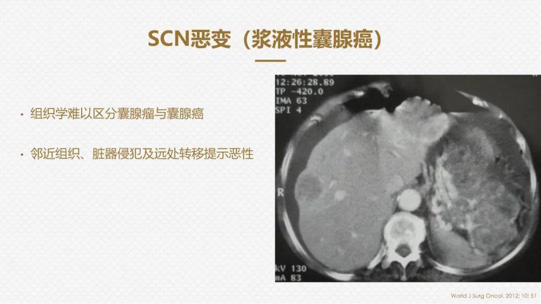 国人提出的"囊外囊"征象可以特异性诊断"胰腺寡囊