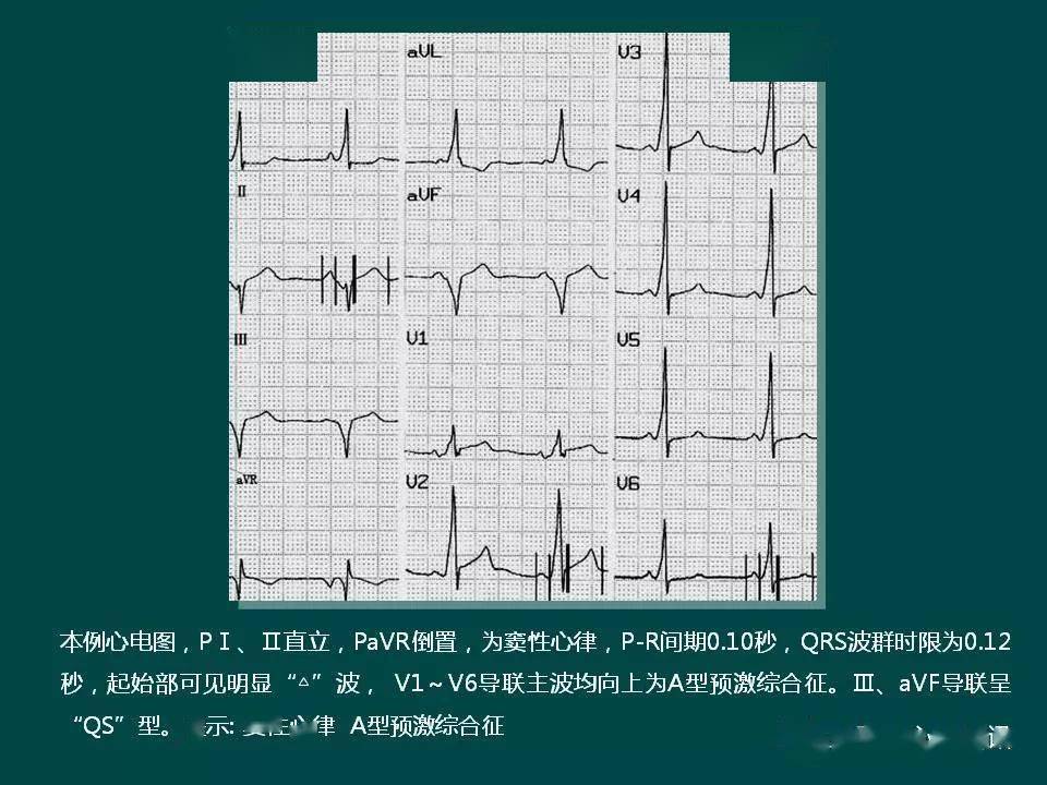 一文搞定 | 预激综合征