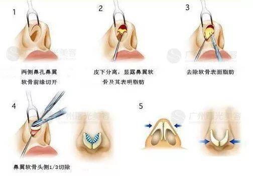 被医美毁掉的女孩,到底有多惨?