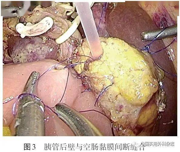 专家共识腹腔镜胰腺外科手术缝合技术与缝合材料选择中国专家共识2021