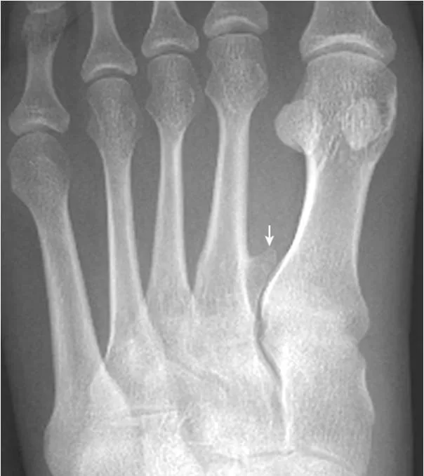 足部x线的正常表现与常见变异及病变建议收藏