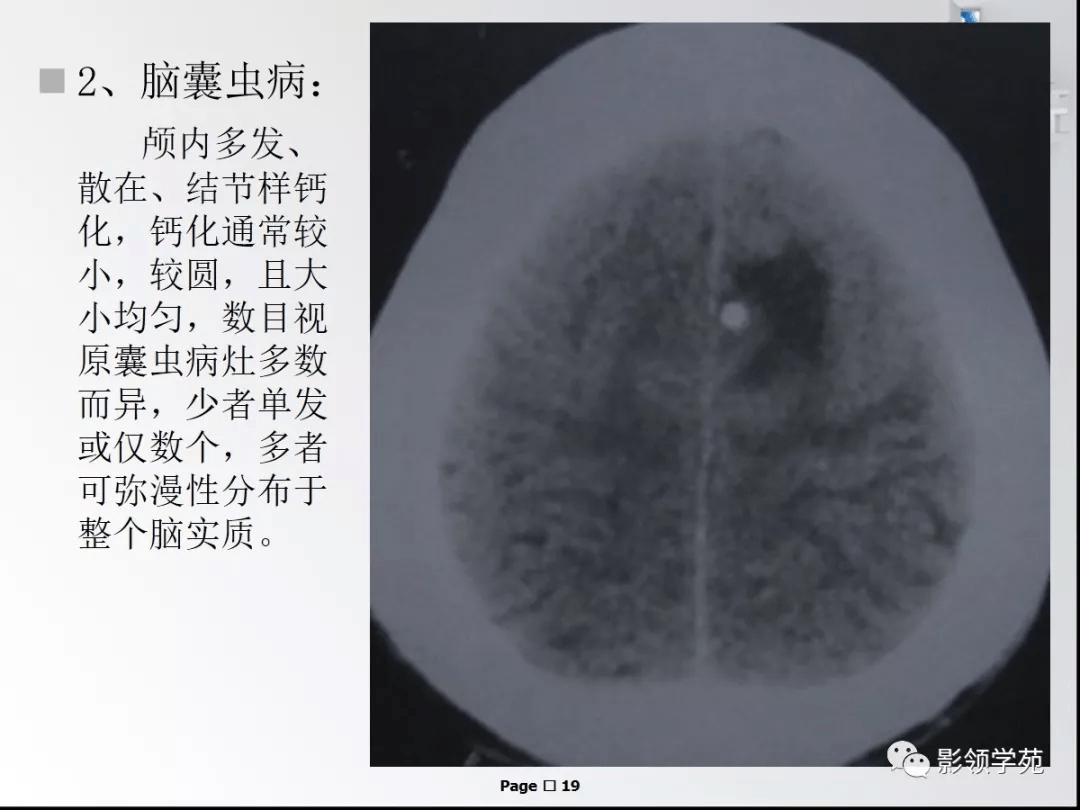 颅内钙化性病变