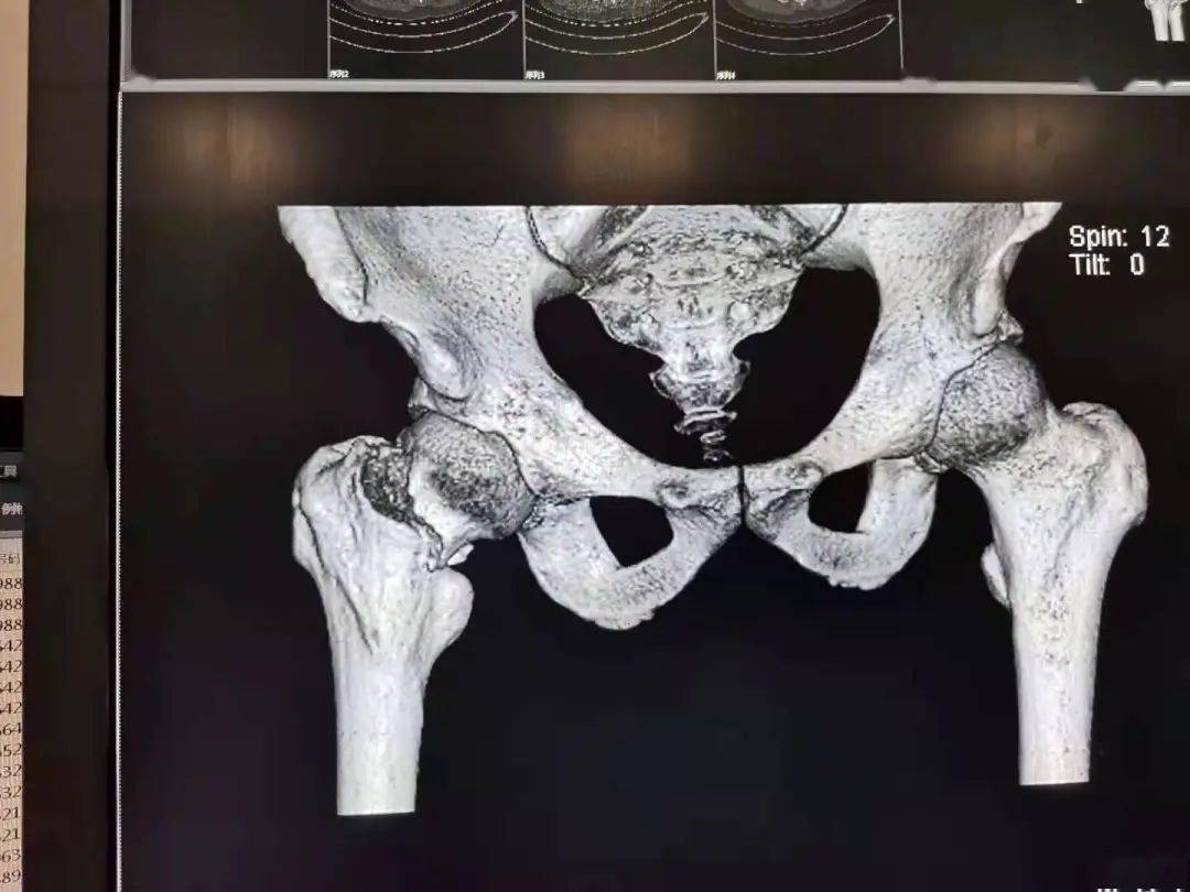海慈医疗集团创伤骨科微创保髋治疗股骨颈骨折