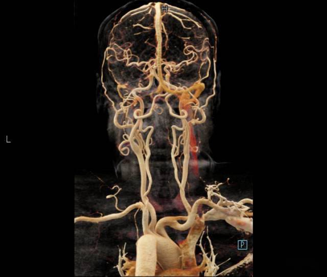 头颈血管cta,后前位观察,带骨和去骨的图像