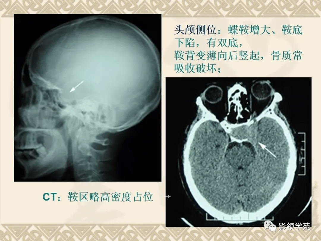 常见脑肿瘤的影像诊断
