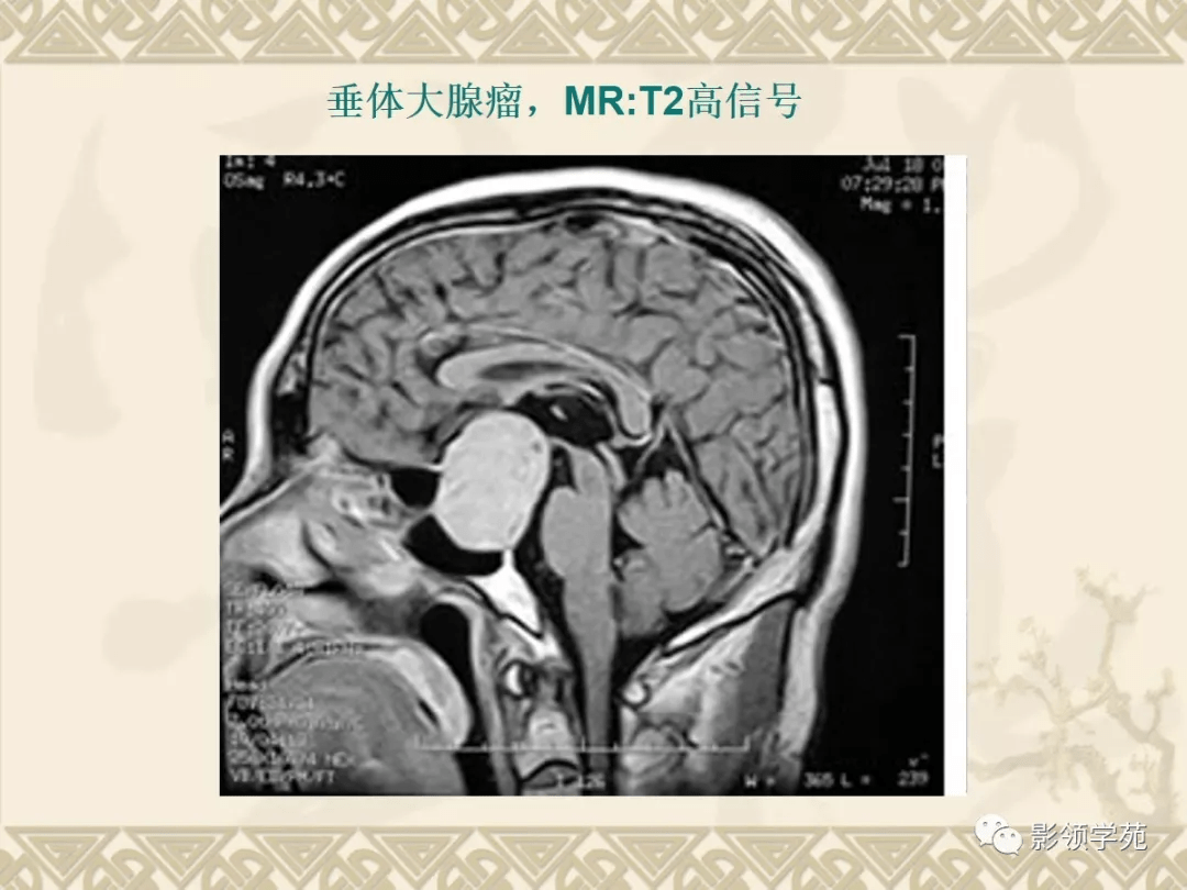 间接征象:鞍底下陷,垂体柄偏移,垂体高度增加,上缘局限隆突.