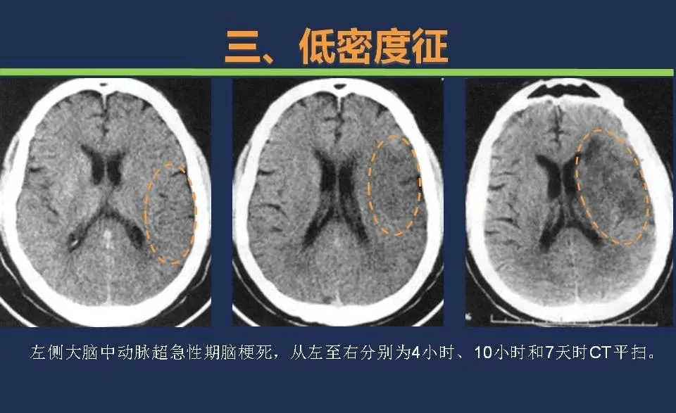 没有mri,超早期如何利用ct诊断脑梗死