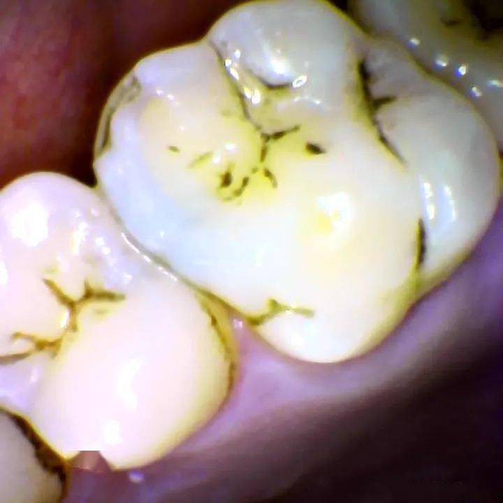 这张图片是牙齿舌侧面菌斑软垢及色素沉着,人群发生率极高,非龋病.