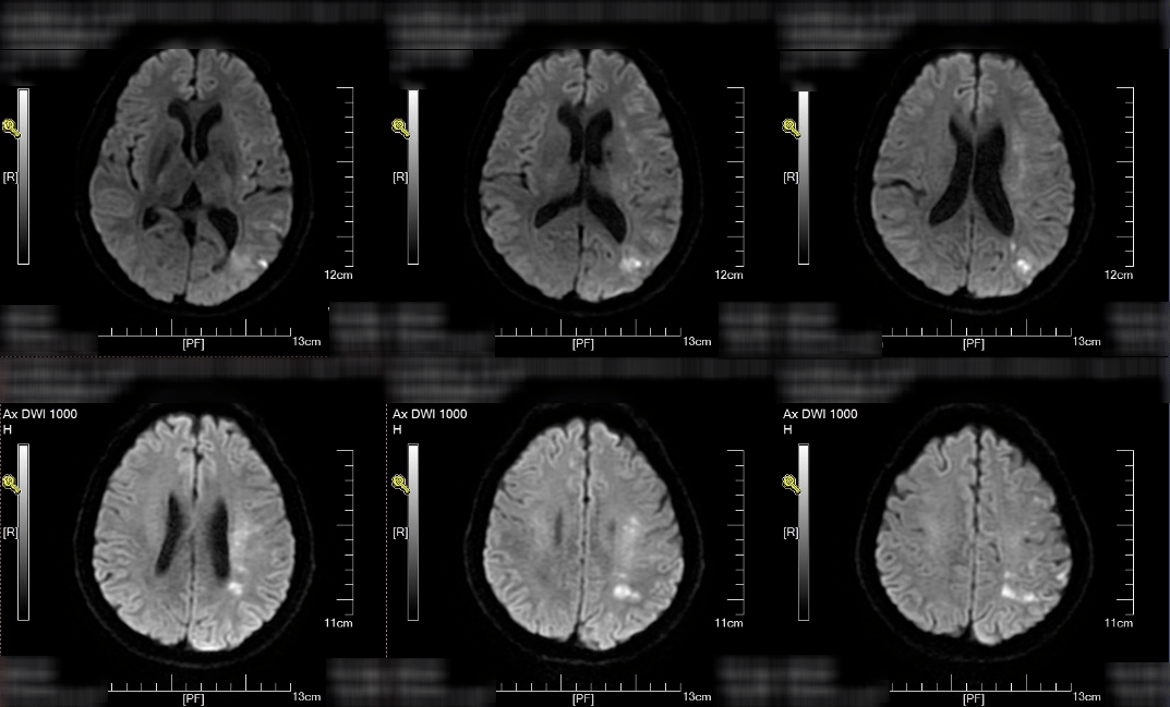 图2:头颅dwi提示左侧侧脑室旁,顶枕叶多发散在新鲜脑梗死.
