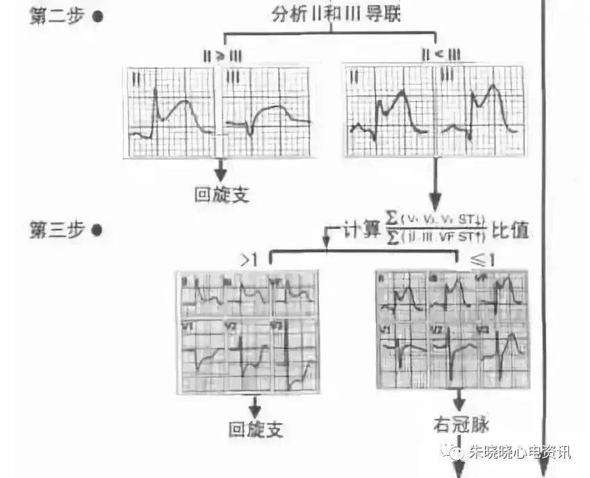 急性正后壁心肌梗死心电图