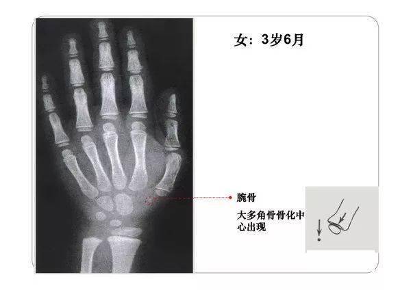 收藏必备丨骨龄图谱修正版