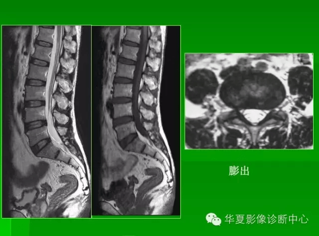 椎间盘的突出,膨出,脱出,髓核游离大家都分清楚了吗?