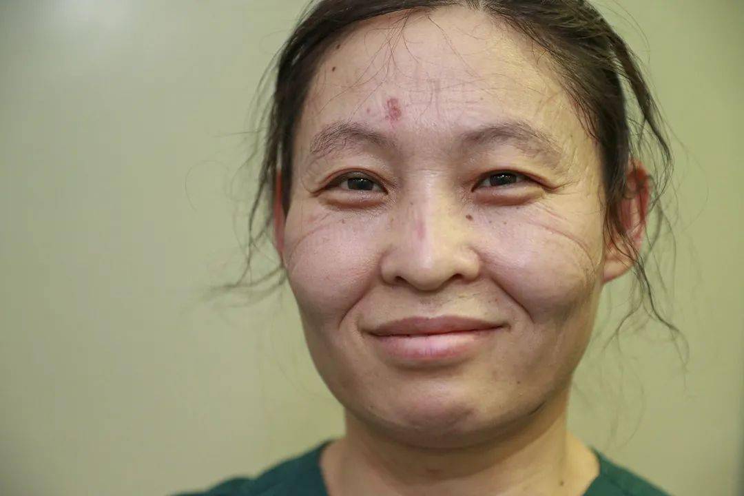 武清援鄂医疗队的护士摘下口罩满脸勒痕,依然保持微笑坚守在防疫
