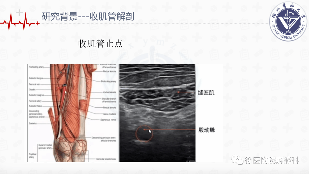 全膝关节置换术中局部浸润麻醉和连续收肌管阻滞结合ipack神经阻滞的