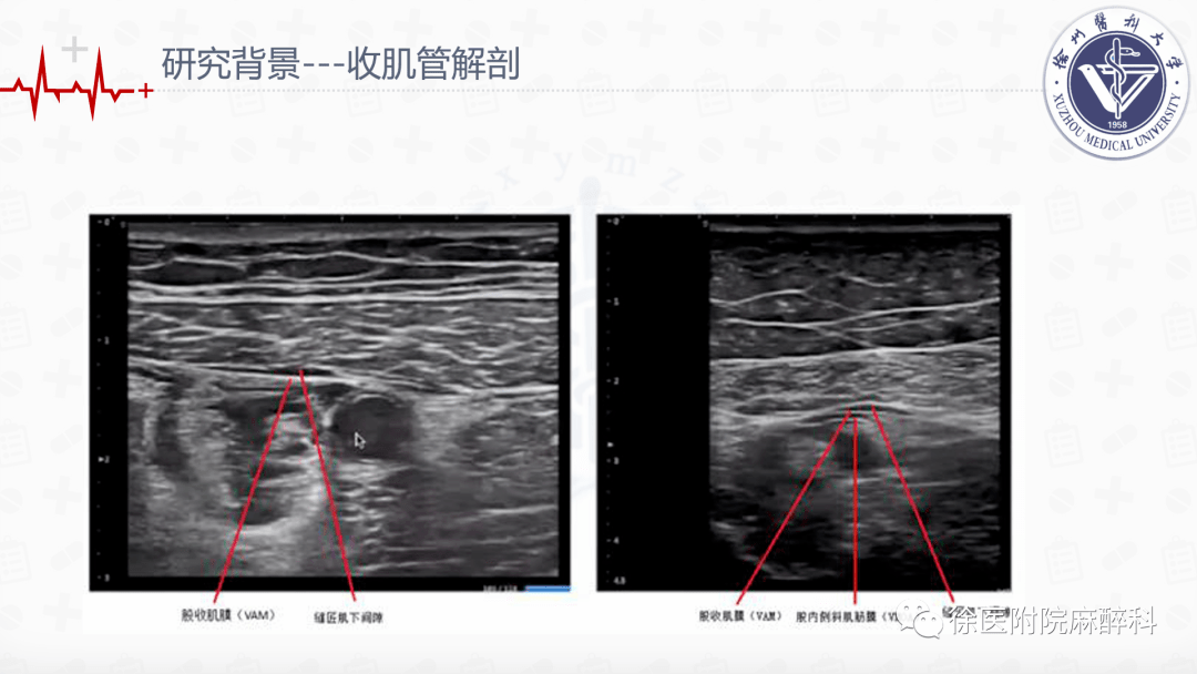 全膝关节置换术中局部浸润麻醉和连续收肌管阻滞结合ipack神经阻滞的