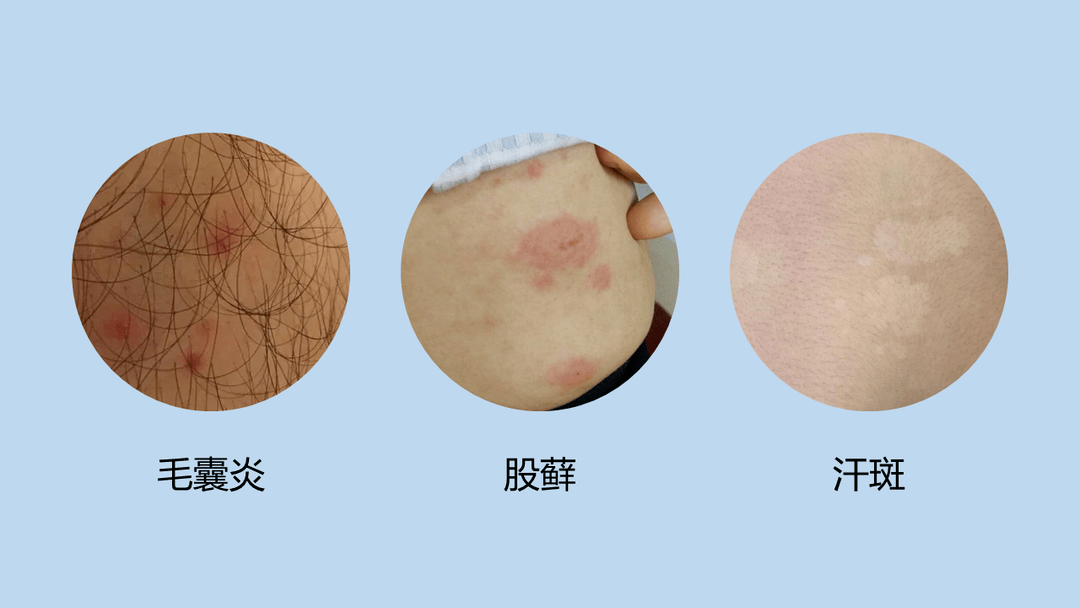 尘埃黏附在皮肤表面,就容易招致葡萄球菌,链球菌和真菌感染,引起毛囊