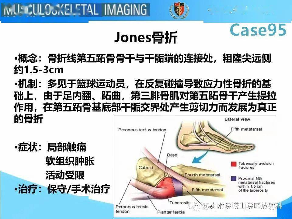 jones骨折