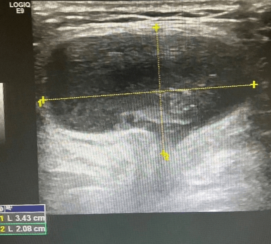 子宫圆韧带囊肿合并腹股沟疝 图 9 左侧腹股沟区包块 超声所见 左侧