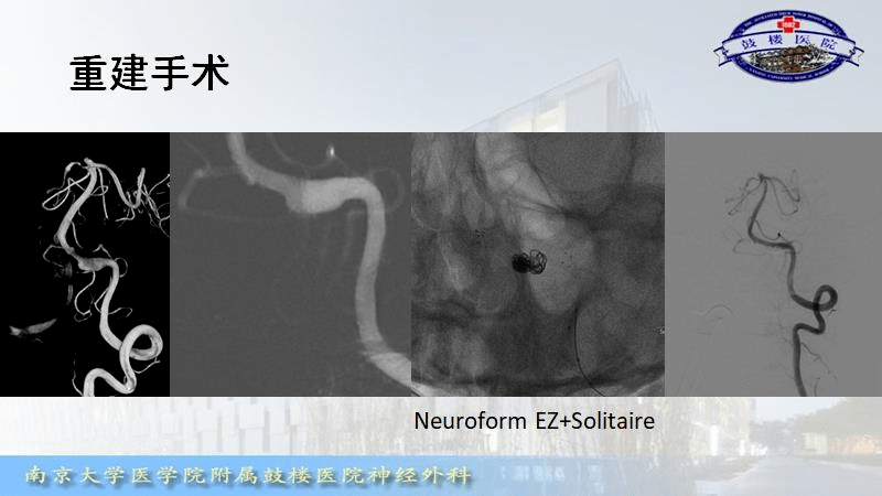 张庆荣教授对团队使用neuroform ez,solitaire,lvis支架辅助栓塞的