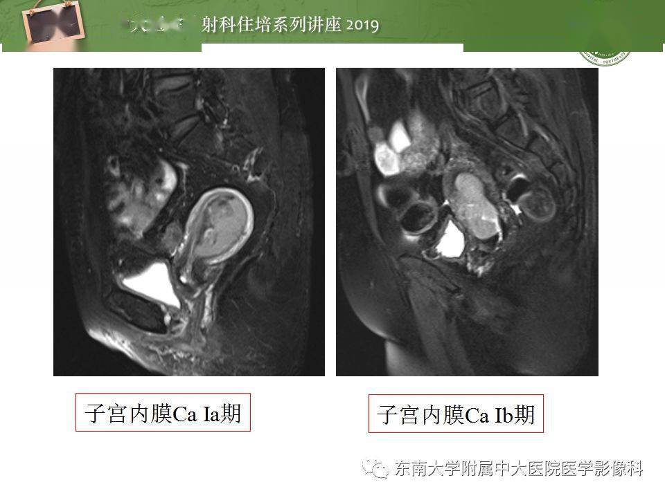 子宫详细解剖及磁共振信号分析