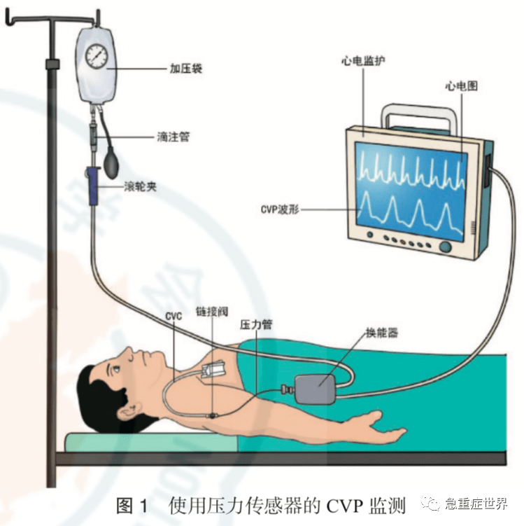 中心静脉压急诊临床应用中国专家共识(2020版)_监测