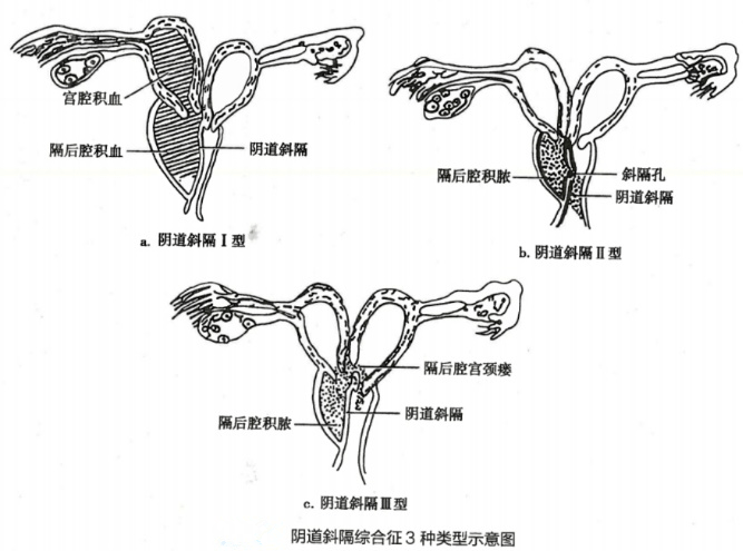 女性生殖器发育异常三