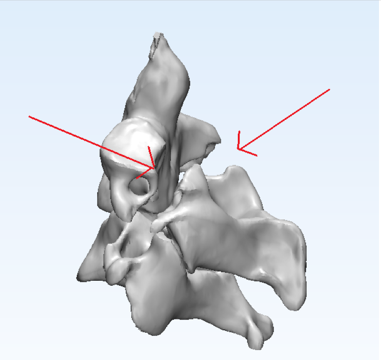 正常的枢椎结构 患者个体化 3d打印模型 红色箭头 为枢椎椎弓根完全