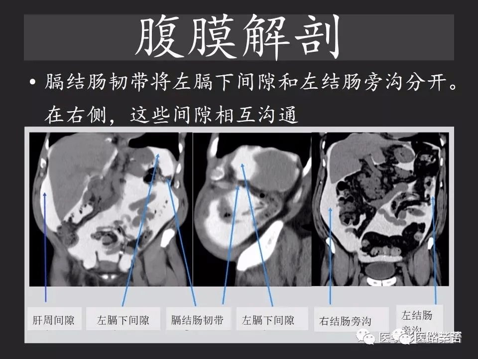 胃肠穿孔:气从哪里来?通过腹膜解剖确定穿孔部位