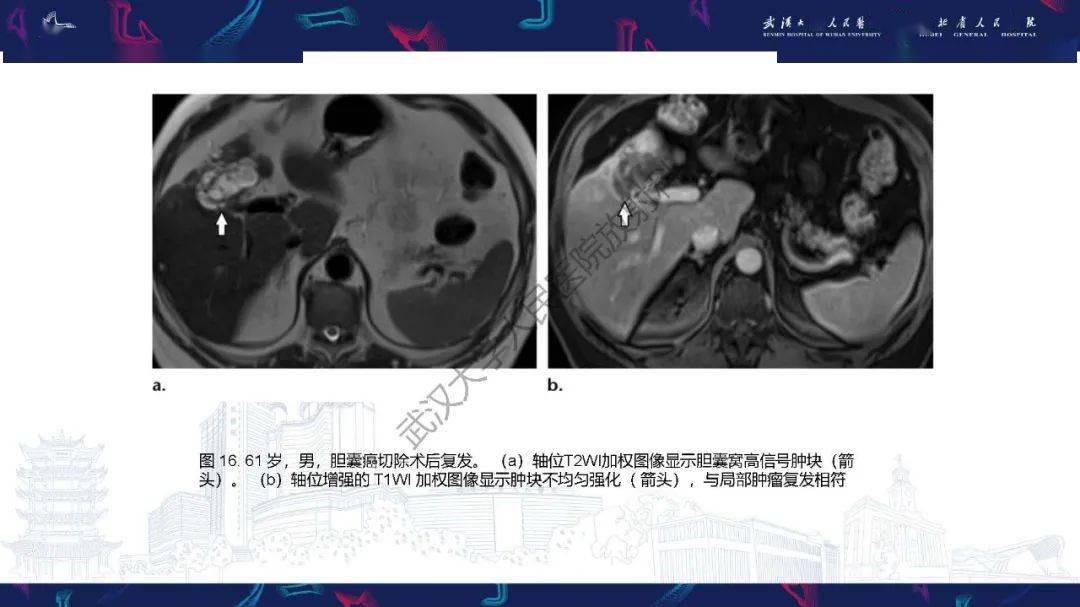 胆囊癌mri诊断