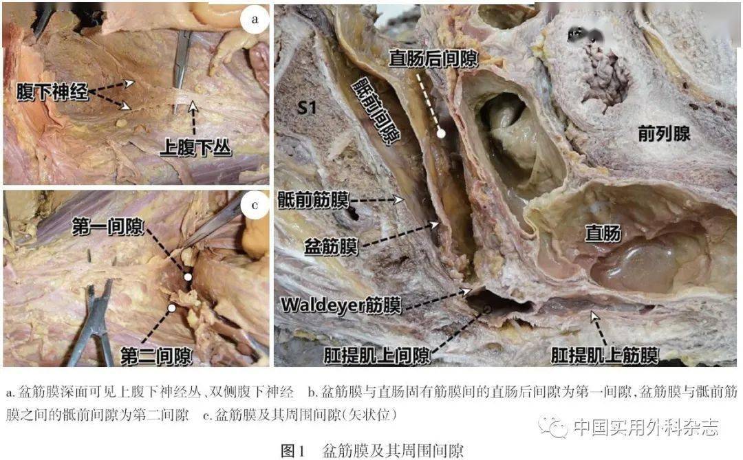 论著盆筋膜解剖及其与直肠固有筋膜关系研究