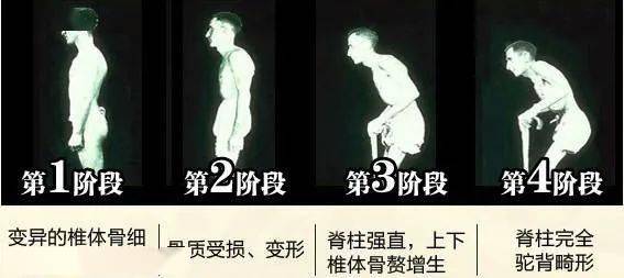 而使患者髋关节不敢作屈伸活动,久之则致髋关节构成骨性强直,构成终身
