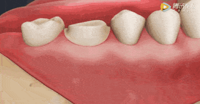 等所有牙根都消毒完毕 牙齿不再疼痛就可以封牙取模 part 9 结束治疗