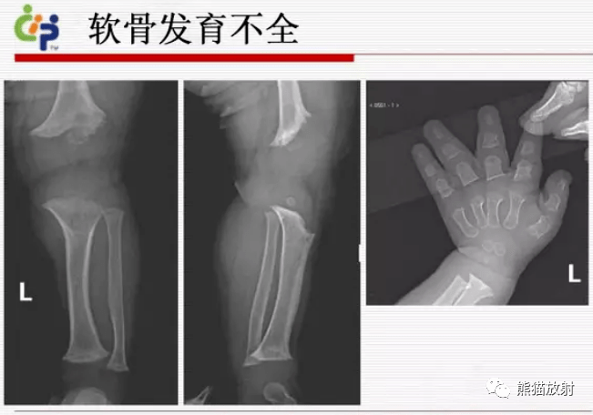 假性软骨发育不全与软骨发育不全如何鉴别?