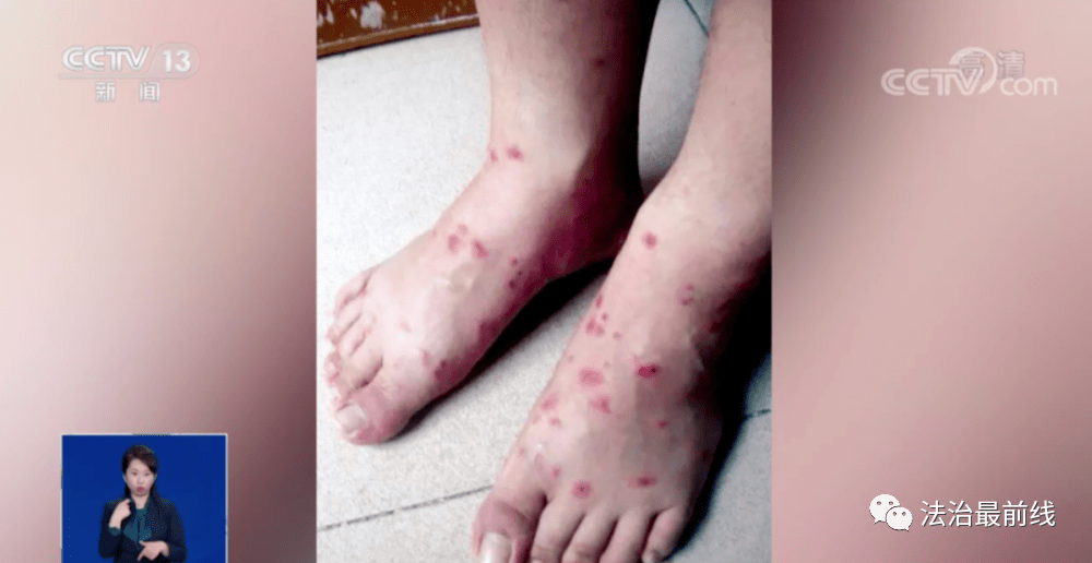 广西一女子被咬后不治身亡!看到这种小红土堆,赶紧躲远点