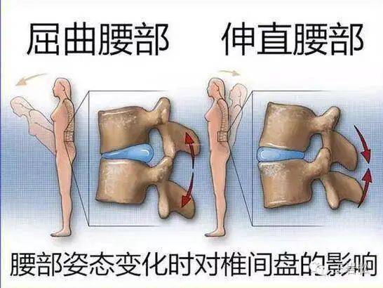 带您了解腰椎间盘突出与腰椎间盘突出症