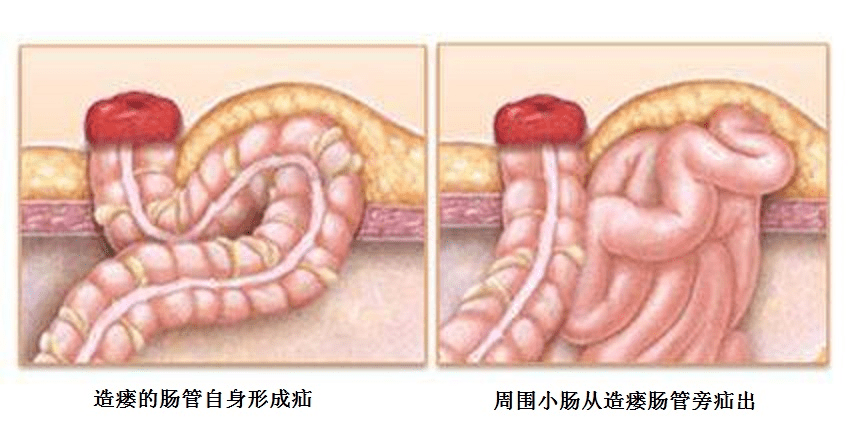 造瘘口旁疝让他度日如年胃肠外科微创手术迅速解忧