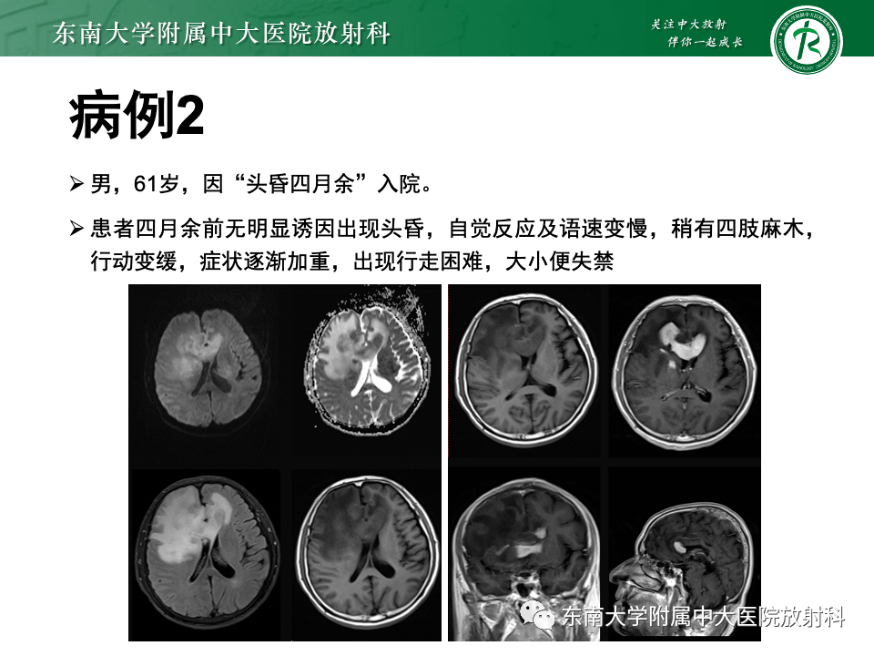 间变型少突胶质细胞瘤