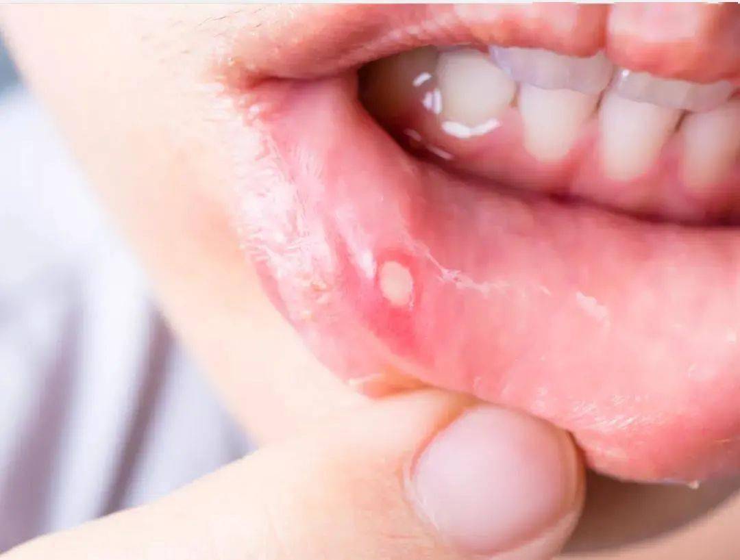 实际上,大多数情况下可能是口唇疱疹,这正是感染了疱疹病毒的体现.