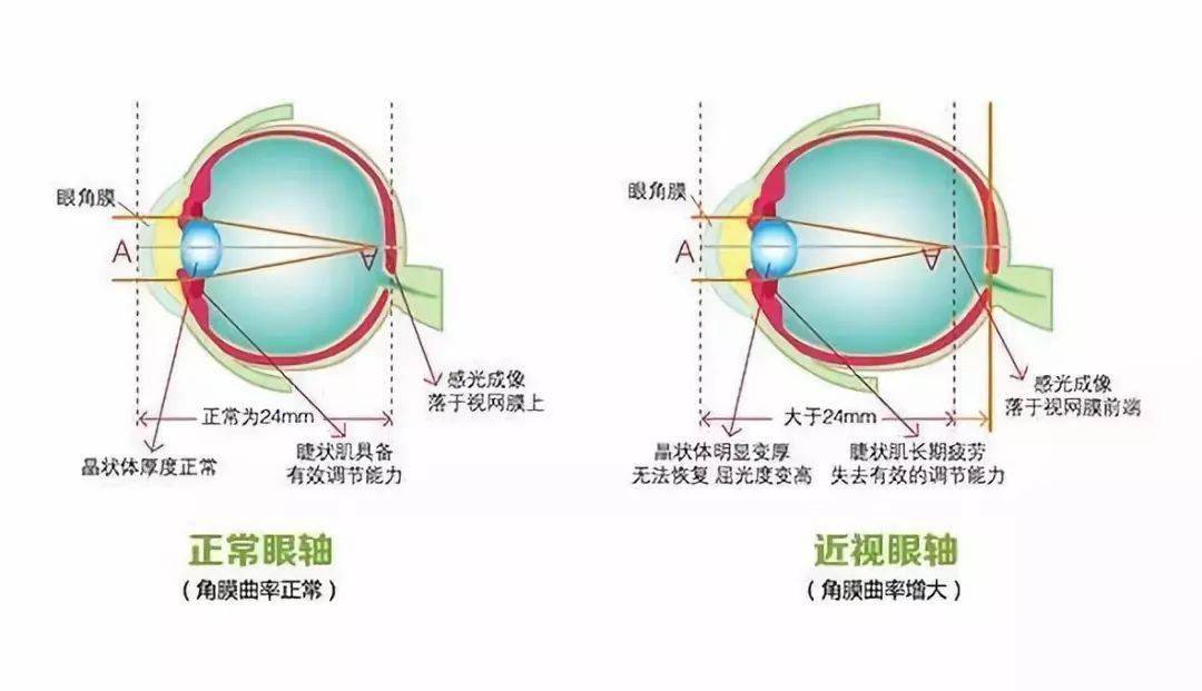 参照上图右侧的图片眼球已经变成了椭圆,眼轴已经发生了明显的变化.