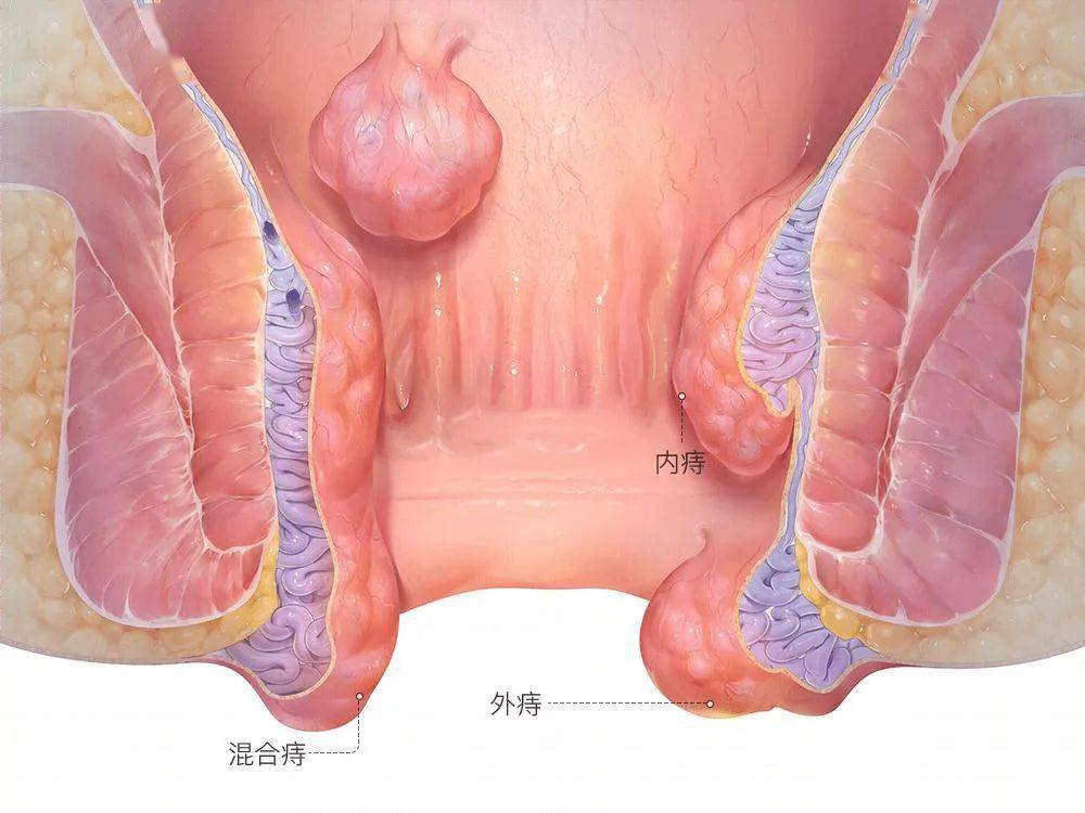 肛周湿疹 肛门尖锐湿疣 直肠脱垂 肛瘘 晚期内痔 肛周湿疹的特
