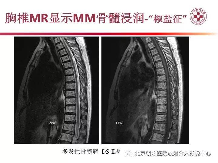 多发性骨髓瘤的影像诊断价值