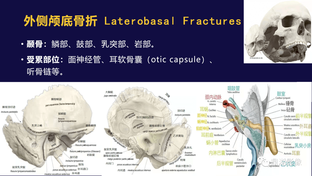 labyrinth:耳软骨囊或骨迷路是指包围内耳膜迷路的颞骨岩部的致密骨