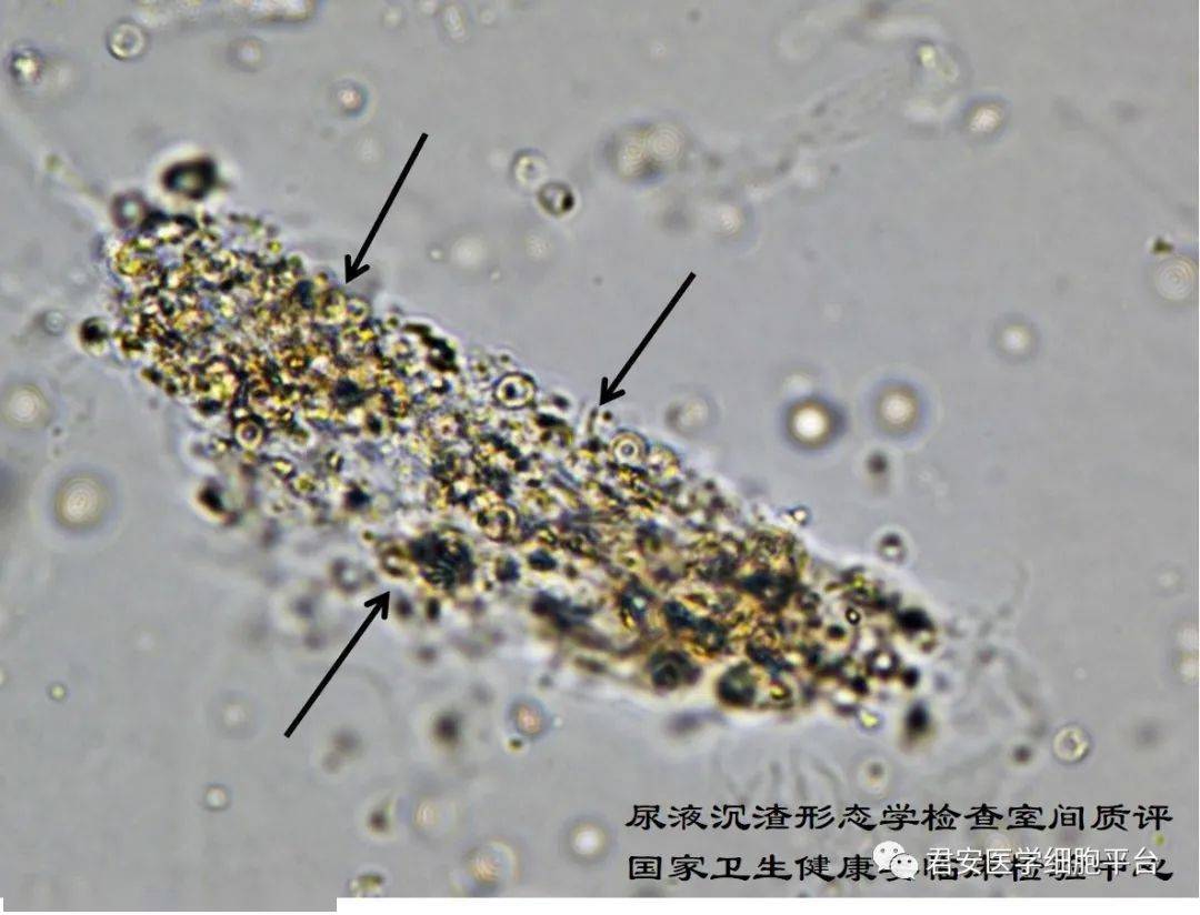 点击空白处查看答案 草酸钙结晶 请报告箭头所指对象的名称 (未染色