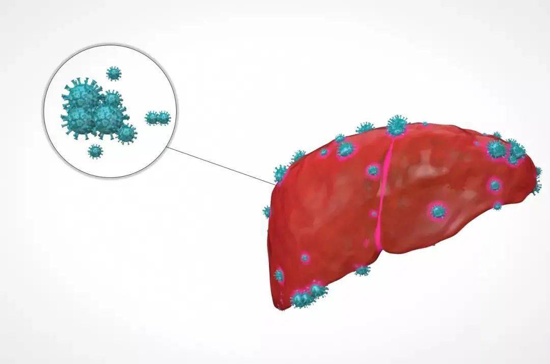 各种原因引起的 急性肝炎(包括黄疸型和无黄疸型),或者慢性乙肝,丙肝